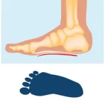 flat feet showin foot impression and joint alignment