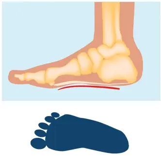 flat feet showin foot impression and joint alignment