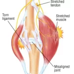 Medical diagram showing the difference between torn ligaments, stretched tendons, and misaligned joints in musculoskeletal injuries