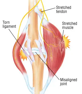 Medical diagram showing the difference between torn ligaments, stretched tendons, and misaligned joints in musculoskeletal injuries